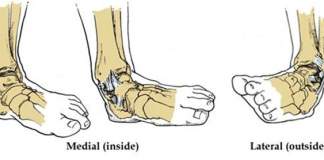 Διάστρεμμα Ποδοκνημικής